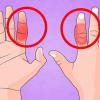 Behandel 'n gebreekte vinger