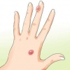 Behandeling van 'n ontsteekte blister