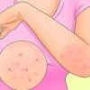 Behandeling van scabies
