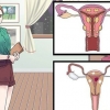 Behandeling van vaginale siste