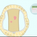 Herkenning van abnormale bloeding tussen menstruasieperiodes