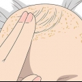 Berg genees