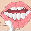 Cheilitis exfoliative genees