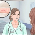 Verligting van die simptome van spongiotiese dermatitis