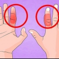 Behandel 'n gebreekte vinger