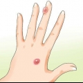 Behandeling van 'n ontsteekte blister