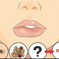 Genees 'n geswelde lip
