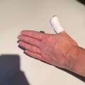 Sit 'n verband om jou duim