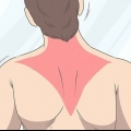 Herwinning van 'n trapezius-stam
