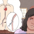 Herstel van 'n angiografie