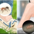 Insectenbeten herkennen