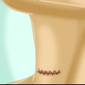 Sorg vir jou insnyding na skildklierchirurgie