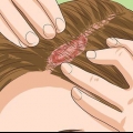 Herkenning van kopvelpsoriase