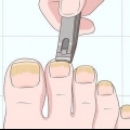 Behandeling van swamnaels