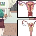 Behandeling van vaginale siste