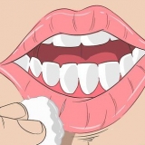 Cheilitis exfoliative genees