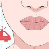 Genees 'n brandwond op jou lippe