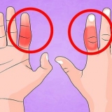 Behandel 'n gebreekte vinger