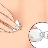 Behandeling van 'n geïrriteerde naeltjiepiercing