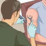 Verwyder 'n tatoeëermerk