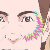 Behandeling van okulêre migraine