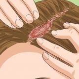 Herkenning van kopvelpsoriase