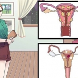 Behandeling van vaginale siste