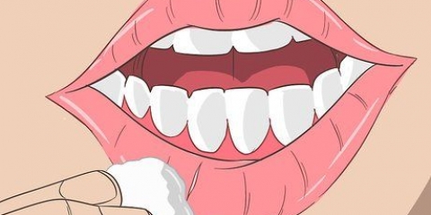Cheilitis exfoliative genees