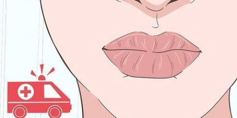 Genees 'n brandwond op jou lippe