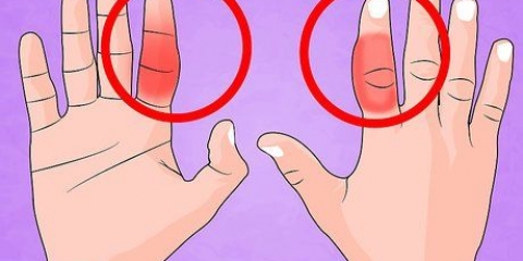 Behandel 'n gebreekte vinger