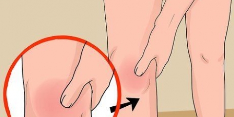 Behandeling van 'n geswelde knie