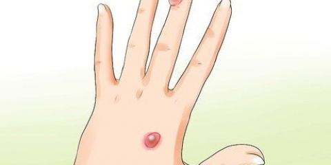 Behandeling van 'n ontsteekte blister