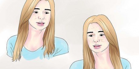 Behandeling van hiperpigmentasie