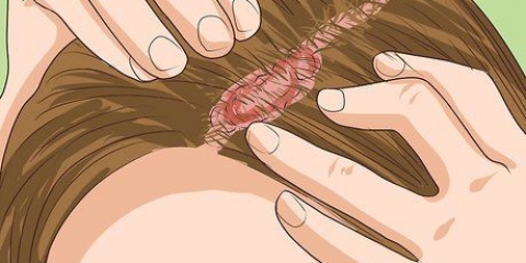 Herkenning van kopvelpsoriase