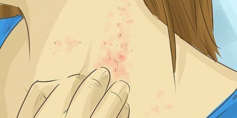 Behandeling van swamvelinfeksies: kan dit natuurlik wees?