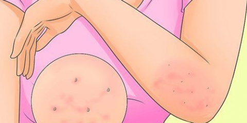 Behandeling van scabies