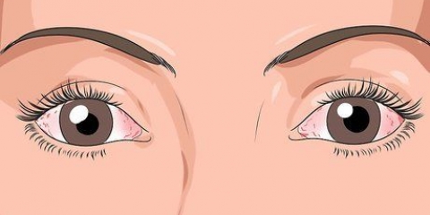 Raak vinnig ontslae van 'n ontsteekte oog