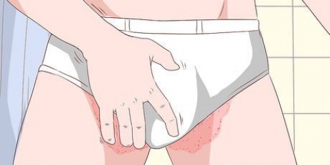 Behandeling van tinea cruris met sudocrem