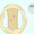 Herkenning van abnormale bloeding tussen menstruasieperiodes