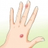 Behandeling van 'n ontsteekte blister