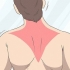 Herwinning van 'n trapezius-stam