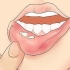 Herpes herpes