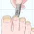 Behandeling van swamnaels