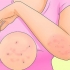 Behandeling van scabies